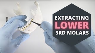 How To Extract Erupted Lower Third Molars  OnlineExodontiacom [upl. by Ynneb]