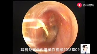 Ear wax removal extraction Ear endoscopy for external auditory canal fungus 12 minutes耳内镜处理外耳道真菌 [upl. by Ogilvy]