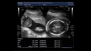 Hydrops fetalis with Fetal Soft tissue edema Ascites and Pleural effusion [upl. by Sukramal]