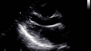 Constrictive Pericarditis Following Heart Transplant 1 [upl. by Yuri]