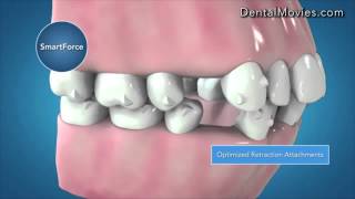 Invisalign G6 Clinical Innovations for First Premolars Extraction [upl. by Ainitsirhc875]