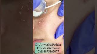 Freckle Removal in Gurgaon For an appointmentCall on 8875865077 or visitwwwdranweshapoddarcom [upl. by Antonius294]