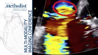 Assessment of the Right Ventricle and Right Sided Valves Echo Sherif Nagueh MD February 22 2022 [upl. by Hervey]