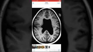 Case 036 Closed lip Schizencephaly and absent septum pellucidum [upl. by Sitnerp]