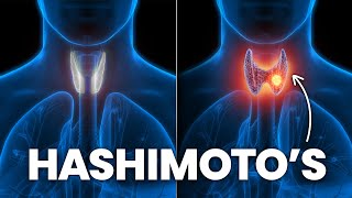 How To Stop Hashimoto’s From Turning Into Hypothyroidism [upl. by Naeruat]