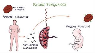 Understanding Rhesus Status and AntiD in Pregnancy [upl. by Nylatsyrc]