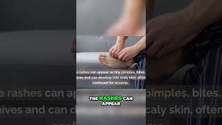 Scabies Symptoms Itching Rashes and Solutions [upl. by Tiemroth208]