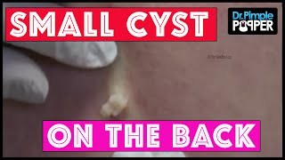 A Nice Little Punch to the Back Cyst [upl. by Gladstone]