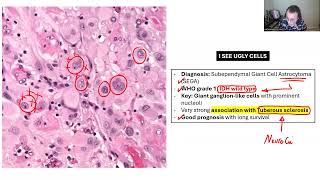 NEUROPATHOLOGY BOARD REVIEW 2 [upl. by Aerdno]