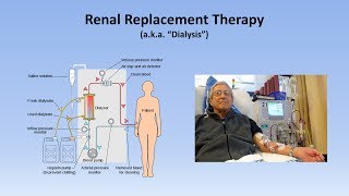 Acute Kidney Injury Part 33  Treatment and Complications [upl. by Sharron]