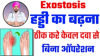 Haddi Ka Badhna Homeopathy Medicine  Haddi Badhna Kya Hota Hai  Homeopathy Medicine For Exostosis [upl. by Israel701]