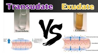 Transudate and Exudate pathology transudate Vs ExudateEasy to understand pathology [upl. by Vitkun735]