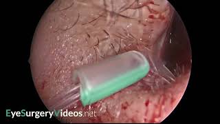 Ritleng bicanalicular nasolacrimal stent insertion [upl. by Calloway990]