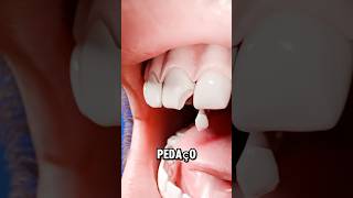 COMO ELES CONCERTAM UM DENTE QUEBRADO😱 curiosidades impressionante curiosidade [upl. by Kaylil]