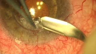 Superficial keratectomy salzmann nodular degeneration [upl. by Otis]