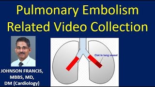 Pulmonary Embolism Related Video Collection [upl. by Namyw]