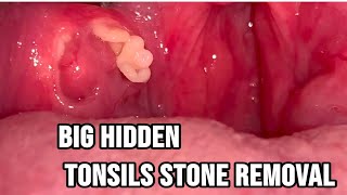 big hidden tonsils stones removal tonsilolith tonsils stones for educational purposes only [upl. by Tamqrah]