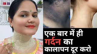 काली गर्दन से छुटकारा मात्र 15 मिनट में घरेलू उपाय How to Remove Dark Neck skinwhitening [upl. by Mendelsohn]