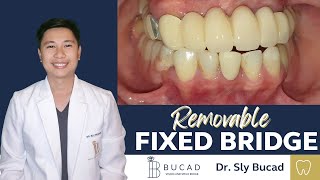 FLEXIBLE DENTURE THAT LOOKS LIKE A FIXED BRIDGE BRIDGE BUT REMOVABLE SMILEREHAB FIXEDBRIGDE [upl. by Aynodal]