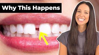 Why Do People Have GAP TEETH amp How To Fix It Diastema Explained [upl. by Mailliwnhoj253]