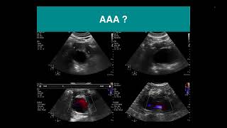 8 Essential POCUS skills for PGY  part 3 AAA [upl. by Aehcsrop]