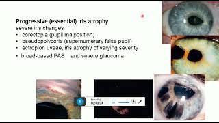 iridocorneal endothelial syndrome [upl. by Atinaej]