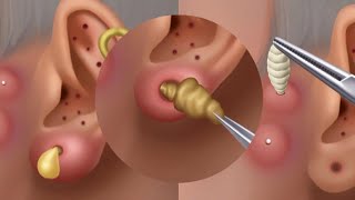 ASMR Ear cleaning and Earwax Removal  asmr animation  satisfying [upl. by Wrigley488]