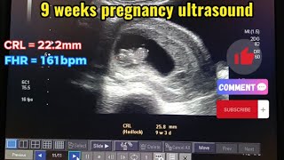 nine weeks pregnant scan video [upl. by Ecela140]