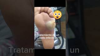 TRATAMIENTO CALLO INFECTADO EN PACIENTE DIABETICA fast edition [upl. by Pelmas]