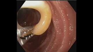 Ascariasis Removal from papilla BDENDOSCOPY [upl. by Rehposirhc]