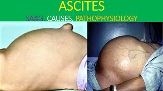 Ascites analysis explained [upl. by Aleunamme779]