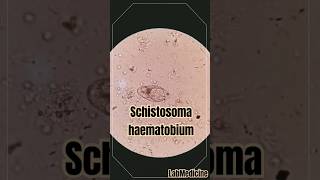 Schistosoma haematobium in urine  Clinical Parasitology [upl. by Gardol658]