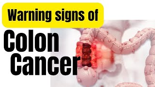 Colon cancer symptoms in Hindi  Colon cancer ke lakshan [upl. by Okimuy]