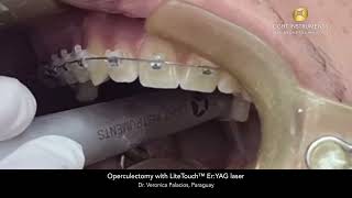 Operculectomy with LiteTouch™ ErYAG laser [upl. by Alikat]