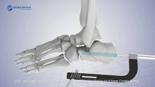 Double Medical Calcaneous Cannulated Screw System [upl. by Felecia103]