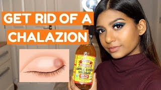 HOW TO GET RID OF A CHALAZION FAST AT HOME [upl. by Adaiha]