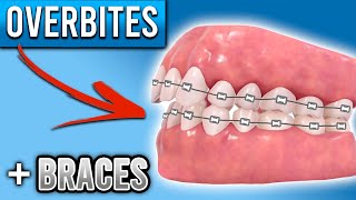 How Do BRACES FIX Overbites  Overbite Before and After Braces  Premier Orthodontics [upl. by Karwan]