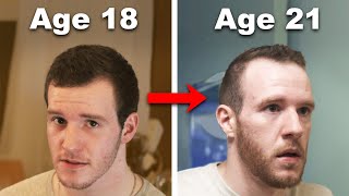 How rapid hair loss changed my life [upl. by Reichert971]