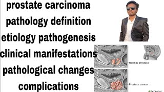 prostate carcinoma  prostate cancer  pathology notes  definitionetiologypathogenesishindi [upl. by Koppel]