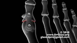 First Metatarsal Phalangeal Joint Fusion for Hallux Rigidus [upl. by Brownley]