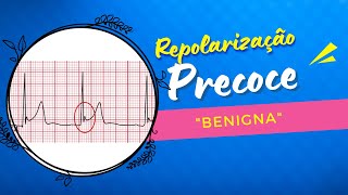 Repolarização Precoce quotBenignaquot [upl. by Aroved]