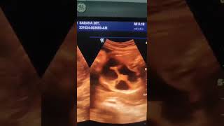 Fetal bowel dilatation Ultrasound shorts video shorts [upl. by Hpseoj]