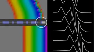 Ablation target for WPW Differential Pacing Maneuvers SVT EPS in Cardiac Electrophysiology [upl. by Haim]