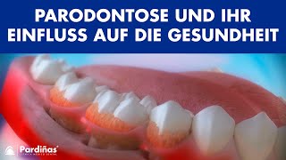 Parodontose und ihr Einfluss auf die Gesundheit © [upl. by Koa]