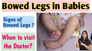 Bowed legs in babies in hindi  Bowed legs के लिए कब डॉक्टर को दिखाएं [upl. by Zebadiah596]