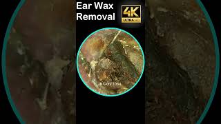 New Video Ear Wax Removal 1021 shorts earwax [upl. by Anar]