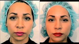 botox antes despues arrugas rejuvenecimiento facial [upl. by Iasi885]