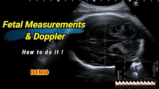 Fetal measurements and Doppler  How to do it [upl. by Meakem]