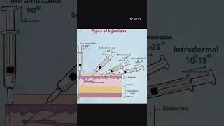 Injection लगने का तरीका । type of injection । injection कैसे लगाए। injection types in hindi shorts [upl. by Malinowski]