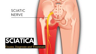 Sciatica Causes Signs and Symptoms Diagnosis and Treatment [upl. by Killian963]